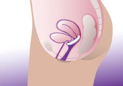 ProFem Urethra Shell Vaginalpessar uden og med støttemembran