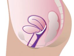 ProFem Marland Vaginalpessar