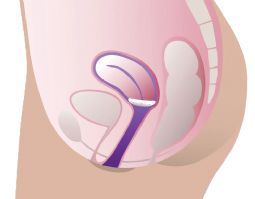 ProFem Shaatz Vaginal pessar