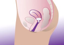 ProFem Gellhorn Pessary - click to see picture in full size - opens new window ProFem Gellhorn Pessary