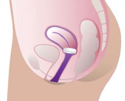 ProFem Donut Pessary