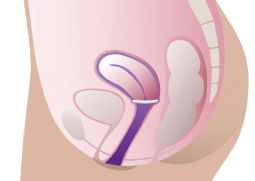 ProFem Ring Pessar with or without support - click to see picture in full size - opens new window ProFem Ring Pessar with or without support